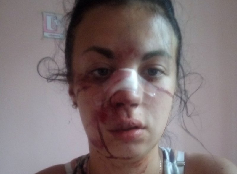Водитель искалечил девушку, снеся её машиной: кошмарные последствия жестокого ДТП в Одессе (ФОТО)