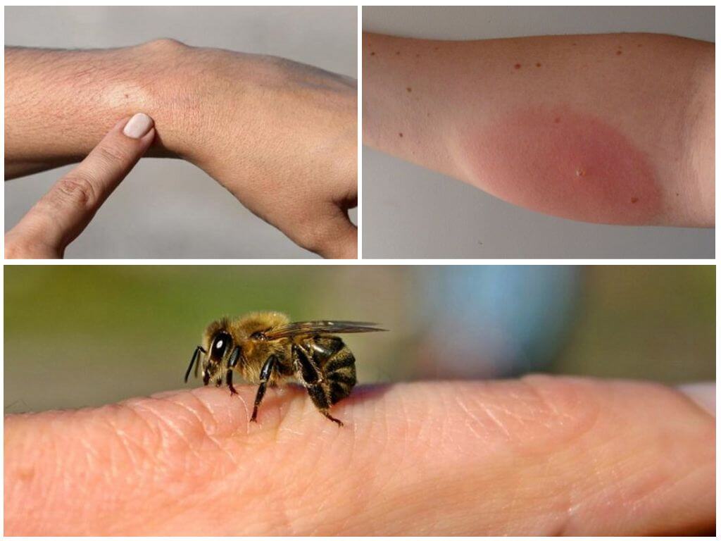 Что делать при укусе осы: первая помощь дома поможет избежать смерти
