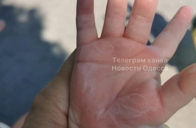 В центре Одессы ребенок получил ожоги, опершись на скульптуру