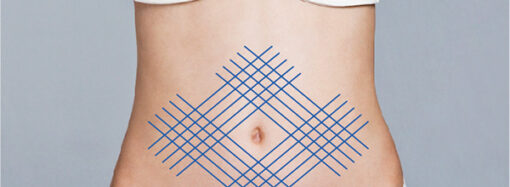 Подтяжка живота и увеличение грудей: преимущества процедур по мнению экспертов клиники «Gold Laser»