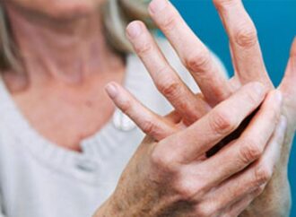 Запитайте у лікаря: чим небезпечний артрит пальців