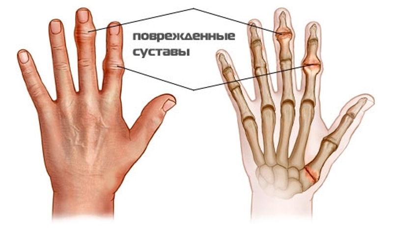 артрит пальцев2
