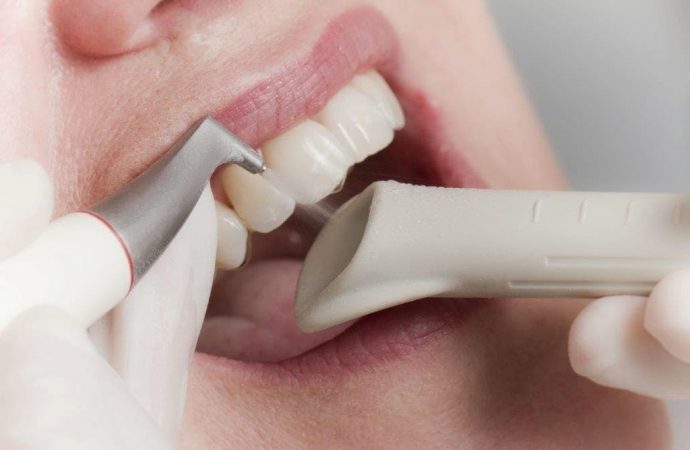 Ультразвуковые скалеры: эффективное удаление зубного налета и отложений