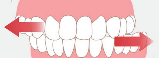 Бруксизм або скрегіт зубами: що це за хвороба і як із нею боротися