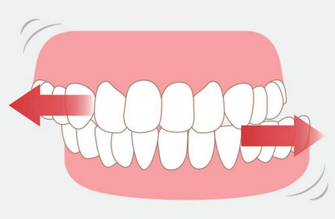 Бруксизм или скрежет зубами: что это за болезнь и как с ней бороться
