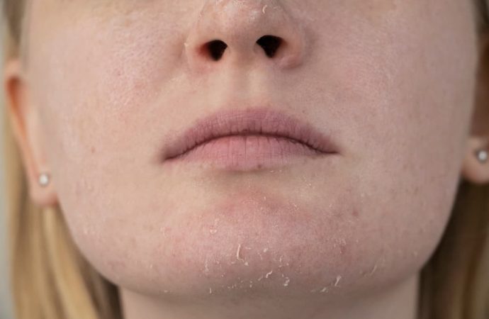 Ксероз: як боротися із сухістю шкіри