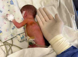 В Одесі зробили унікальну операцію на серці немовляті вагою 900 грамів