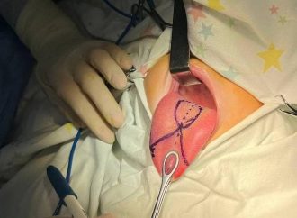 Маленькому одесситу провели уникальную операцию — укоротили язык