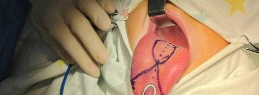 Маленькому одесситу провели уникальную операцию — укоротили язык