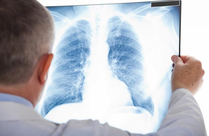 Одеситів запрошують безкоштовно перевірити легені: де і коли