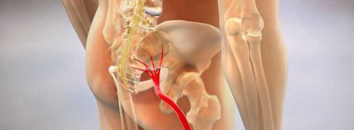 «Мурашки» в ногах і параліч: як розпізнати і що робити з невралгією сідничного нерва