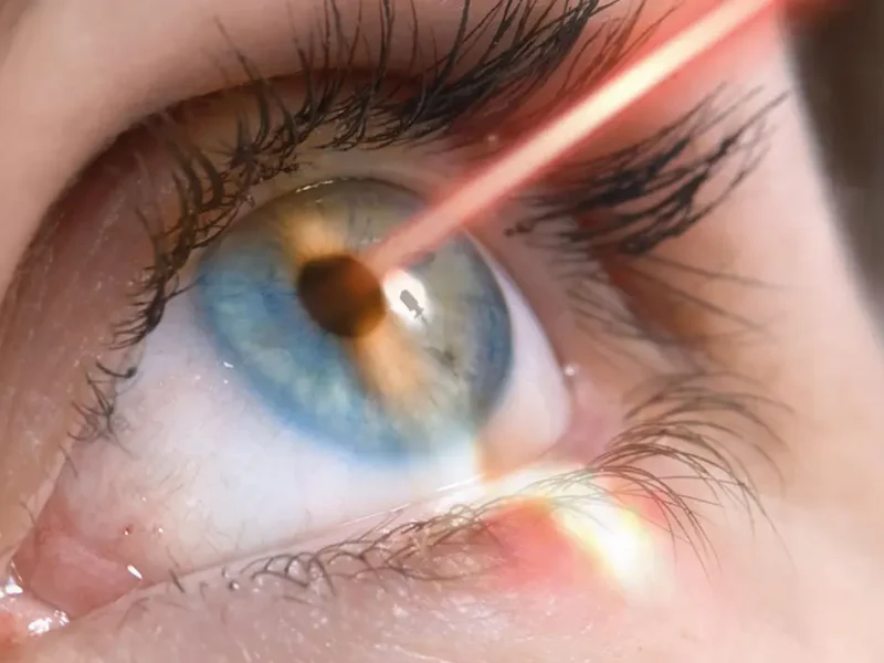 лазерная коррекция зрения