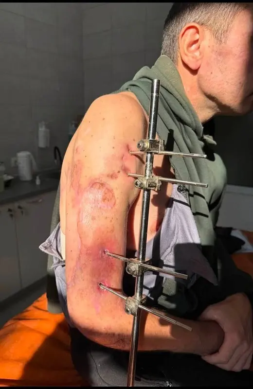Одесские врачи спасли руку раненому защитнику с помощью современных технологий